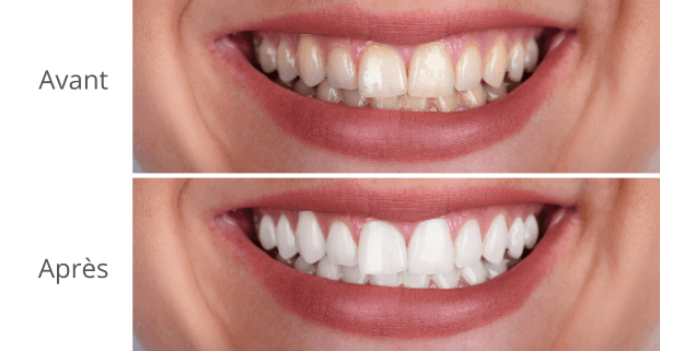 Les prix selon les techniques de blanchiment dentaire