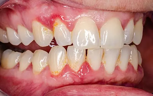 Pourquoi une mauvaise hygiène buccale pose un vrai problème