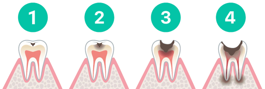 Que se passe-t-il si une carie n’est pas traitée ?