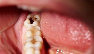 Quels sont les signes d'une carie dentaire ?