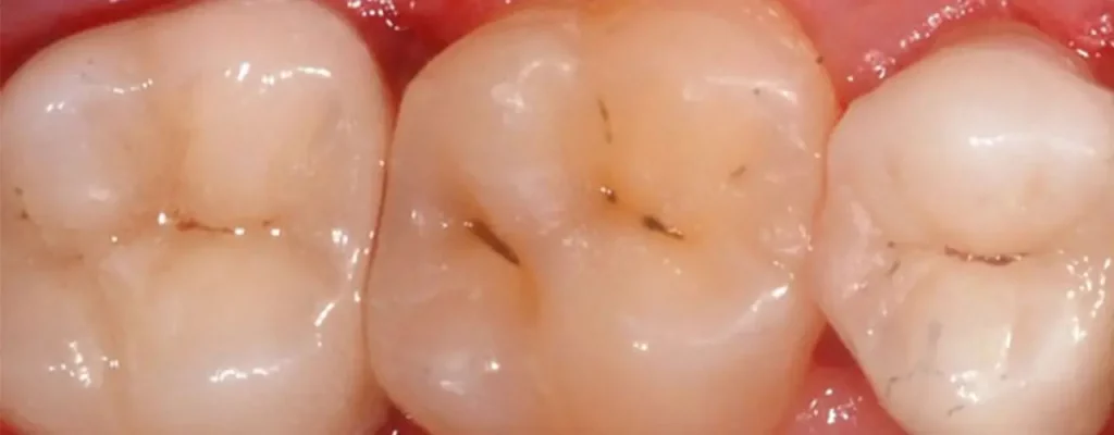 Qu’est-ce qu’une carie dentaire, simplement ?