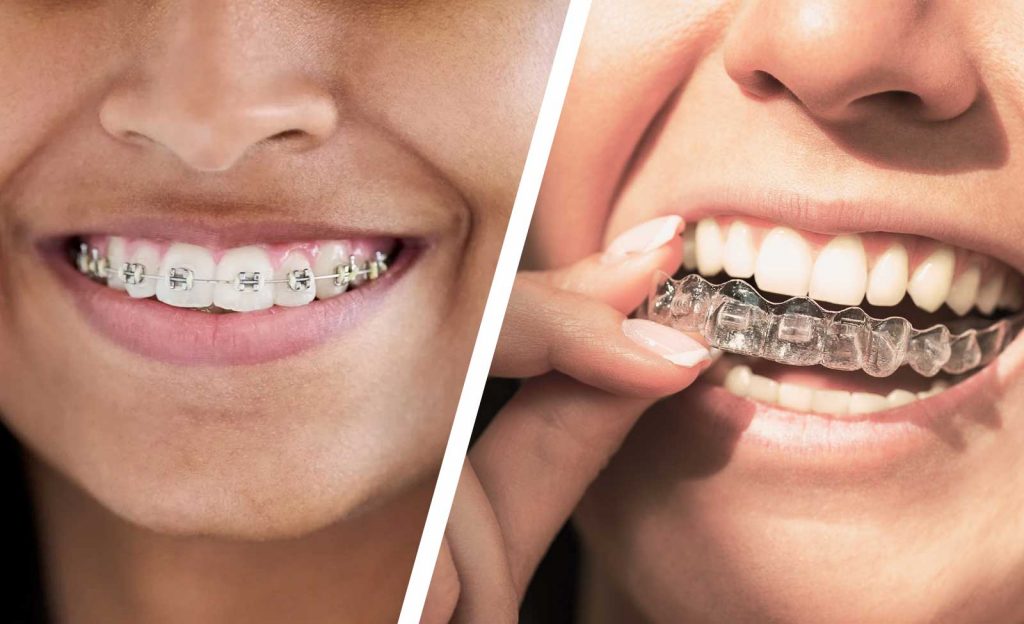 Combien de temps dure un traitement Invisalign à Paris ?