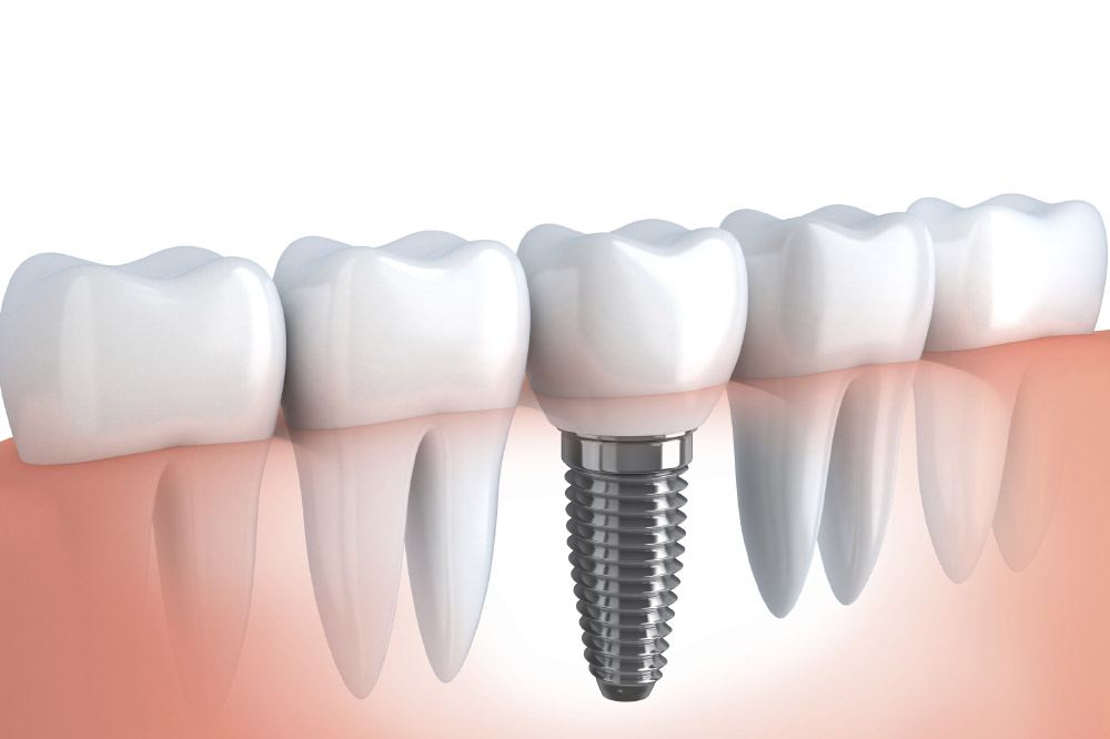 Comment se déroule la pose d’un implant dentaire ?