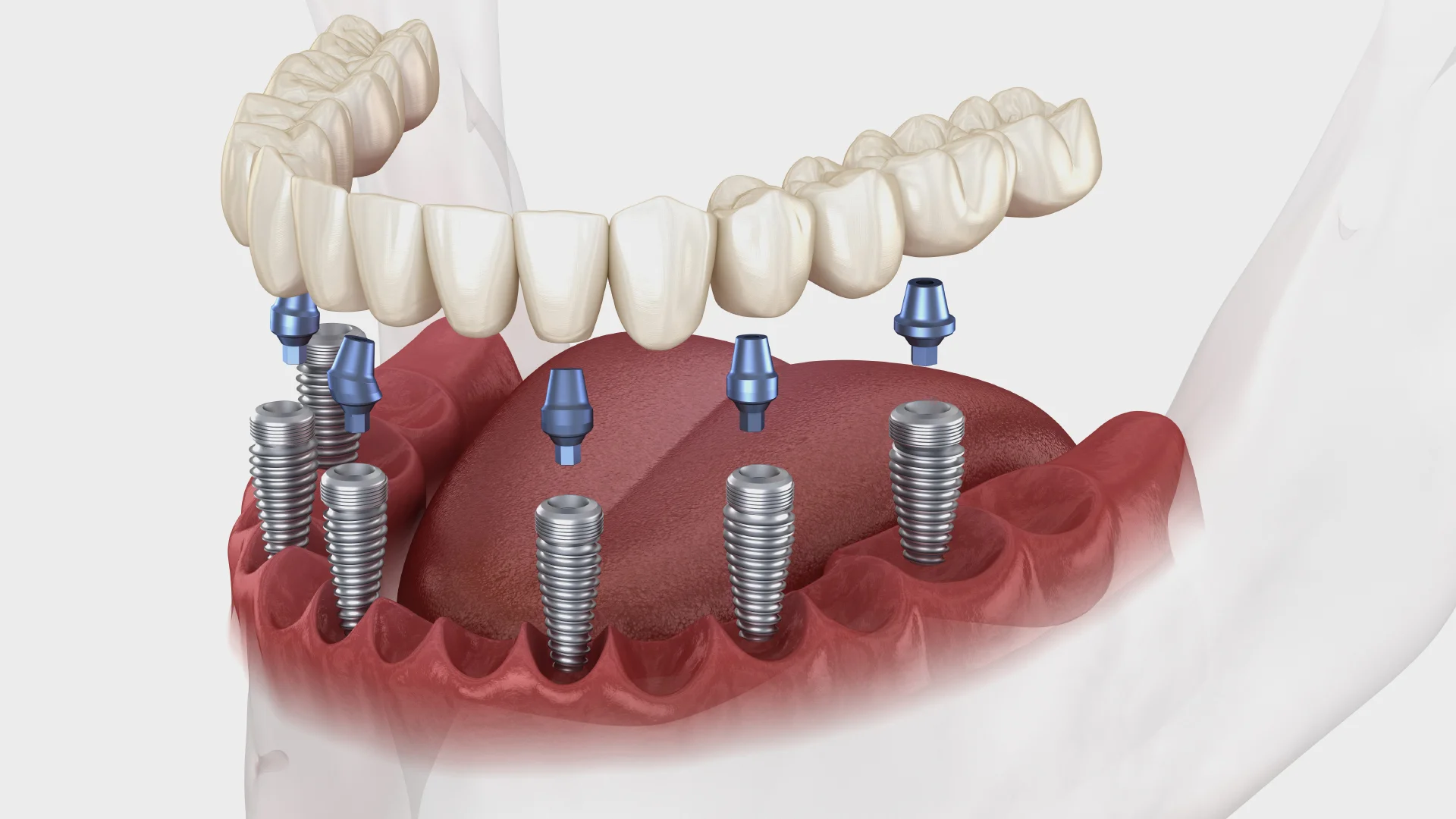 Dans quels cas poser un implant dentaire ?