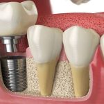 Implant dentaire : prix, pose, avantages et guide complet 2025
