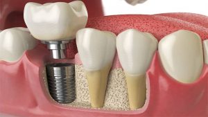 Implant dentaire : prix, pose, avantages et guide complet 2025