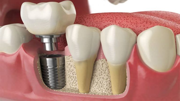Implant dentaire : prix, pose, avantages et guide complet 2025
