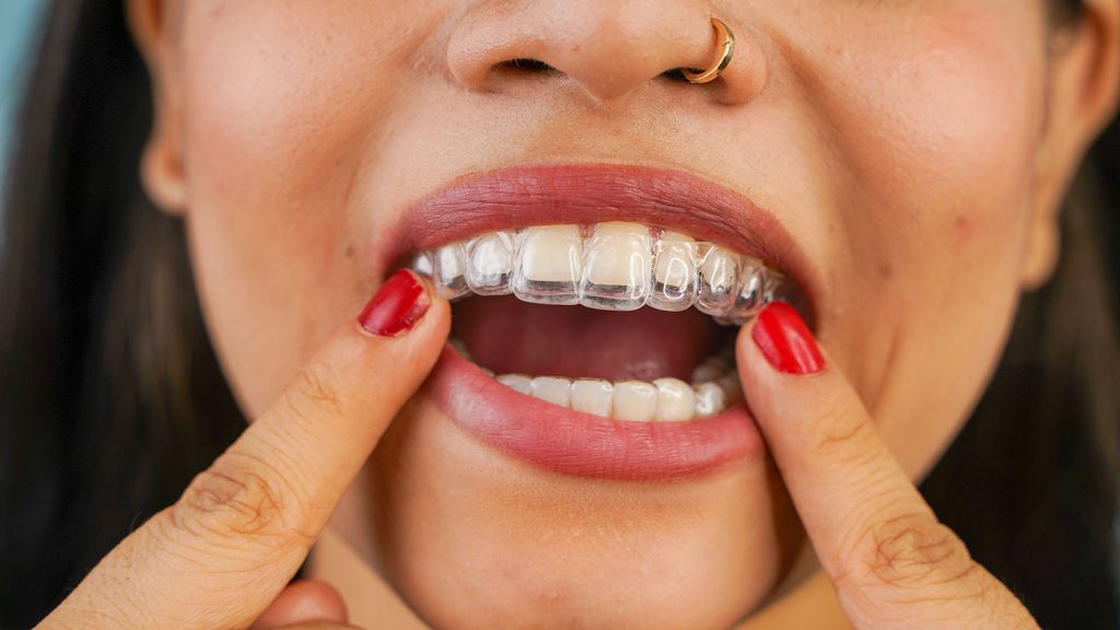 Quel est le prix d’Invisalign à Paris ?