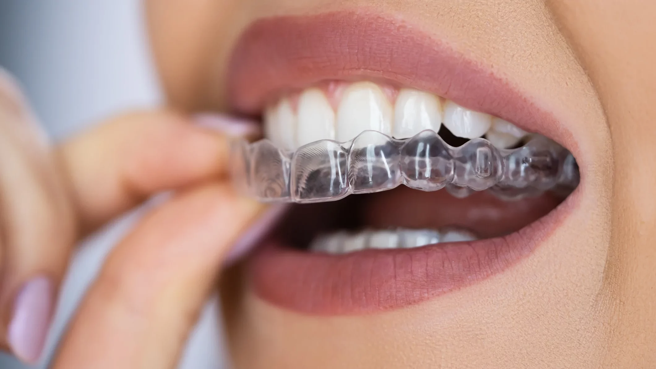 Qu’est-ce qu’Invisalign et pourquoi choisir ce traitement à Paris ?