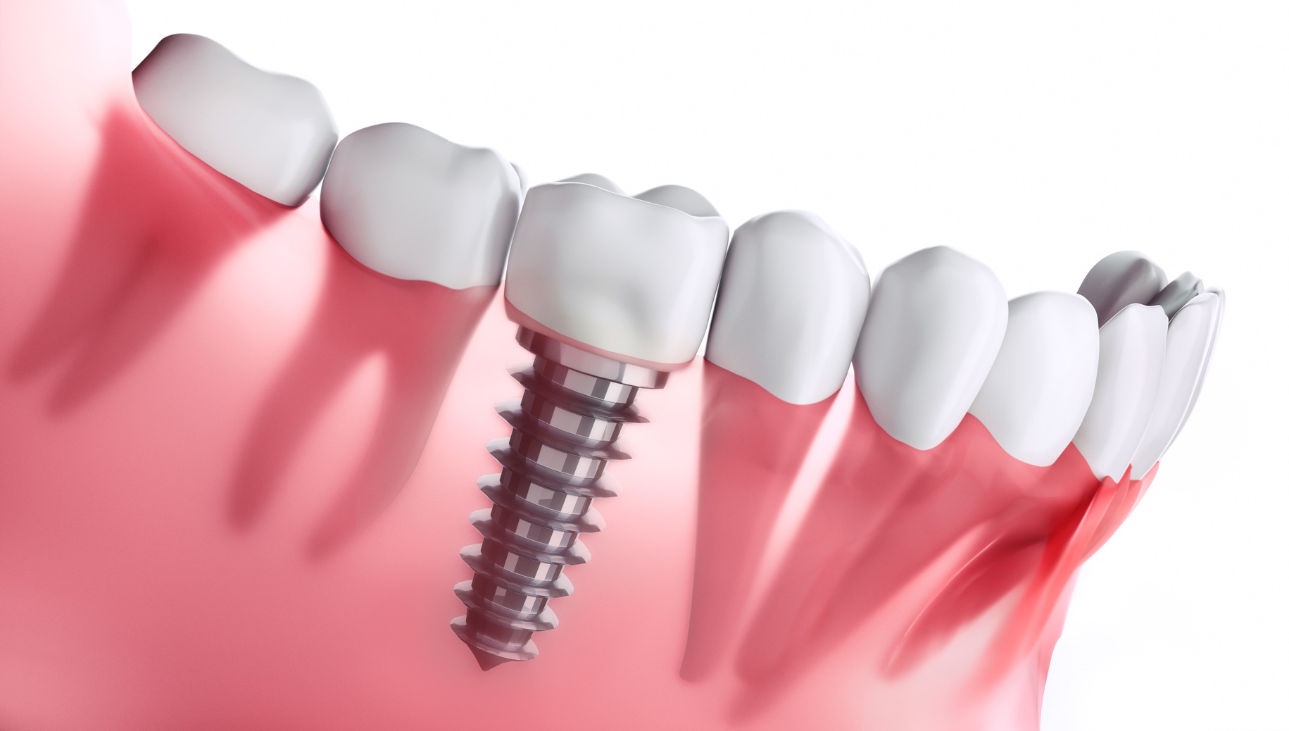 Qu’est-ce qu’un implant dentaire